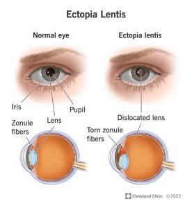 what do lentis feel like