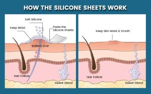 how do silicone scar sheets work