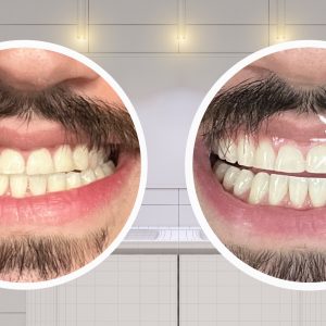 how long does the effect of crest whitestrips last